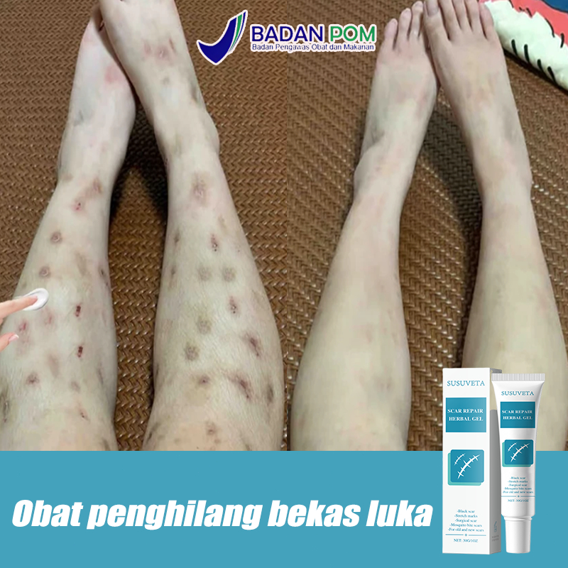 Penghilang bekas luka hitam koreng penghilang bekas luka cream penghilang bekas luka koreng 30g beka