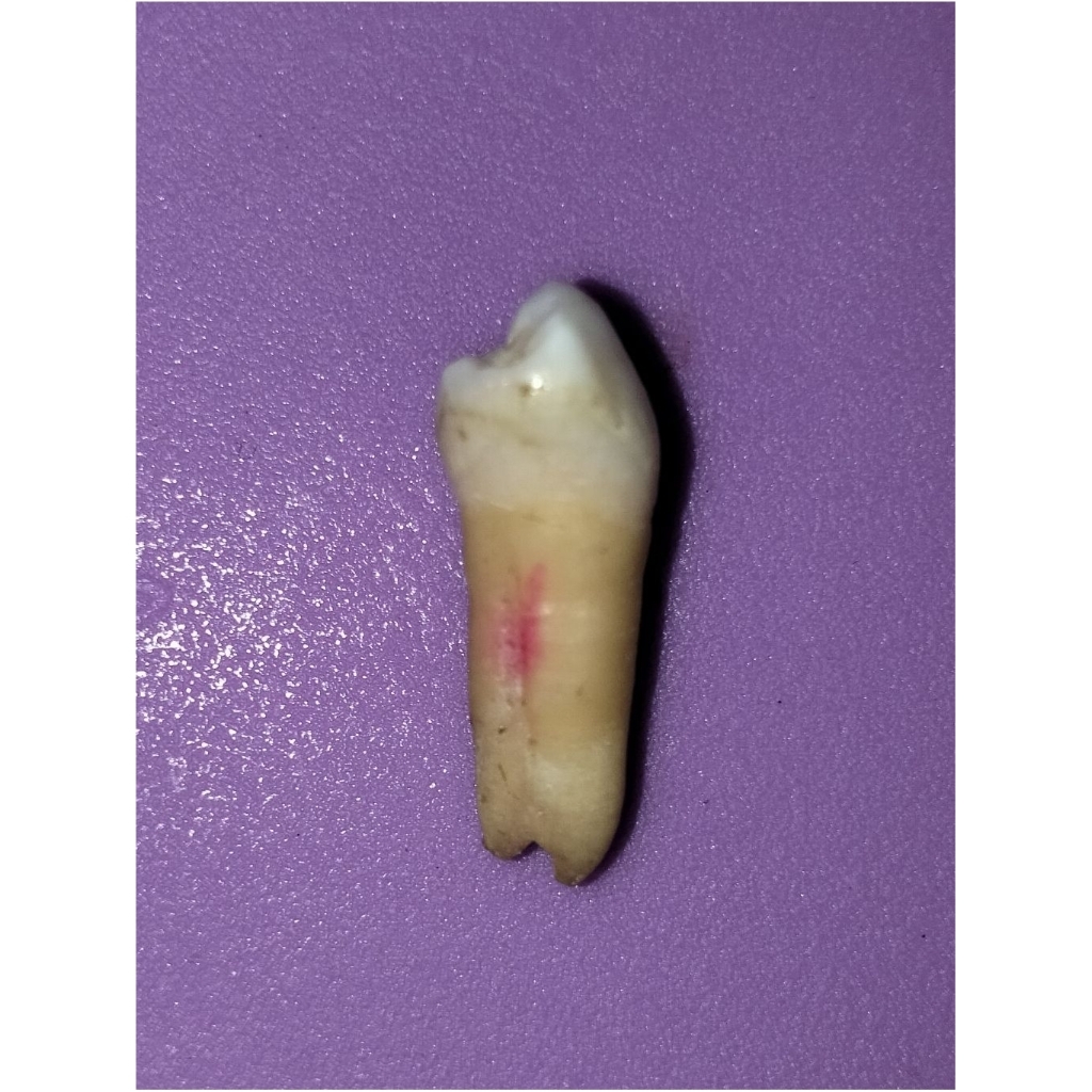 Gigi asli premolar 34
