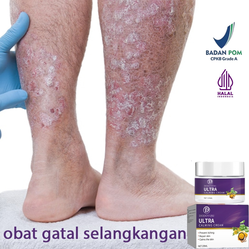 Salep china untuk gatal gatal obat gatal selangkangan dan hitam salep kulit 20g Salep selangkangan g
