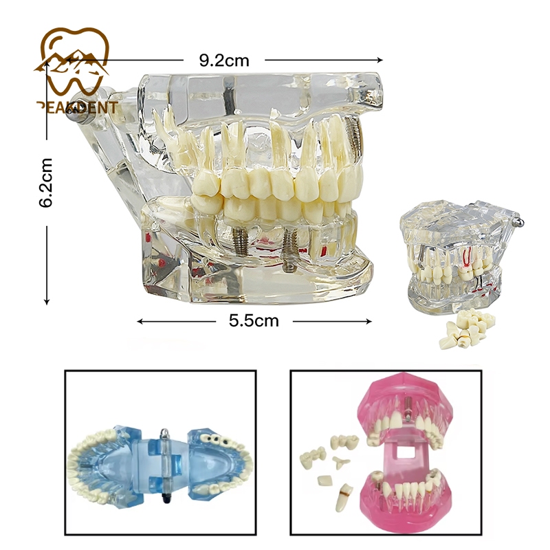 1PC Model Studi Gigi Studi Pendidikan Transparan Implan Phantom Crown Caries Bridge Clear Dampak Mod