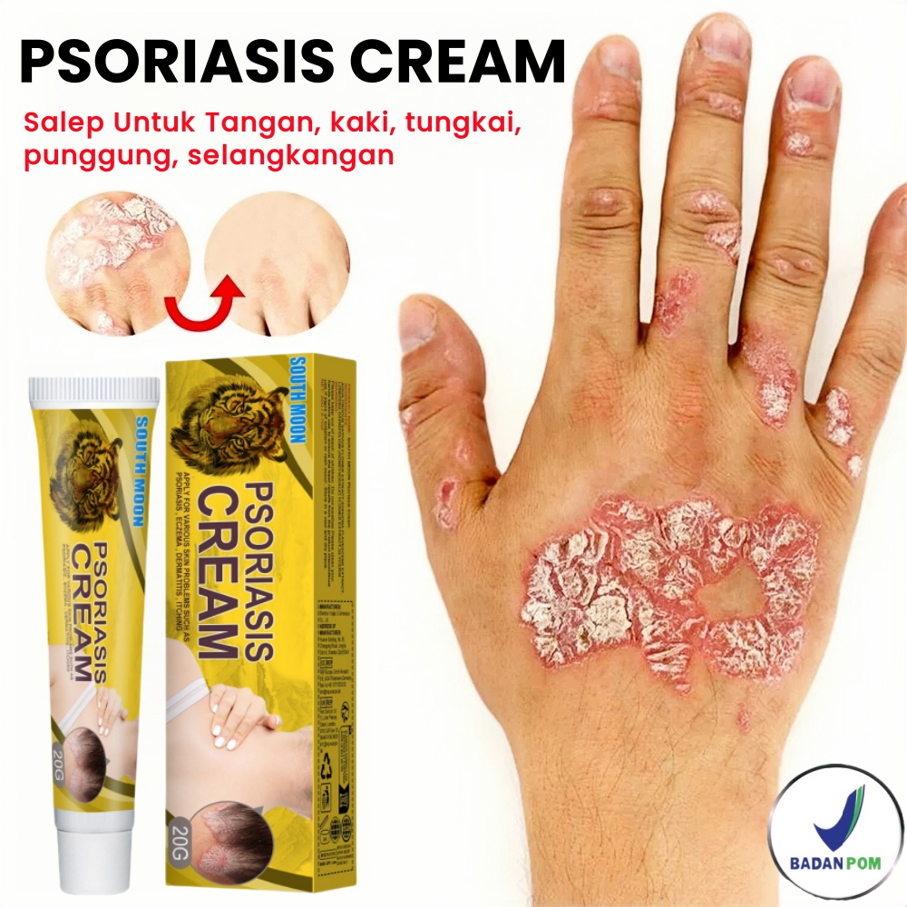 [Bisa COD] Psoriasis Cream Anti Gatal Obat Eksim Kering Ampuh Obat Gatal Eksim Kulit Salep Psoriasis