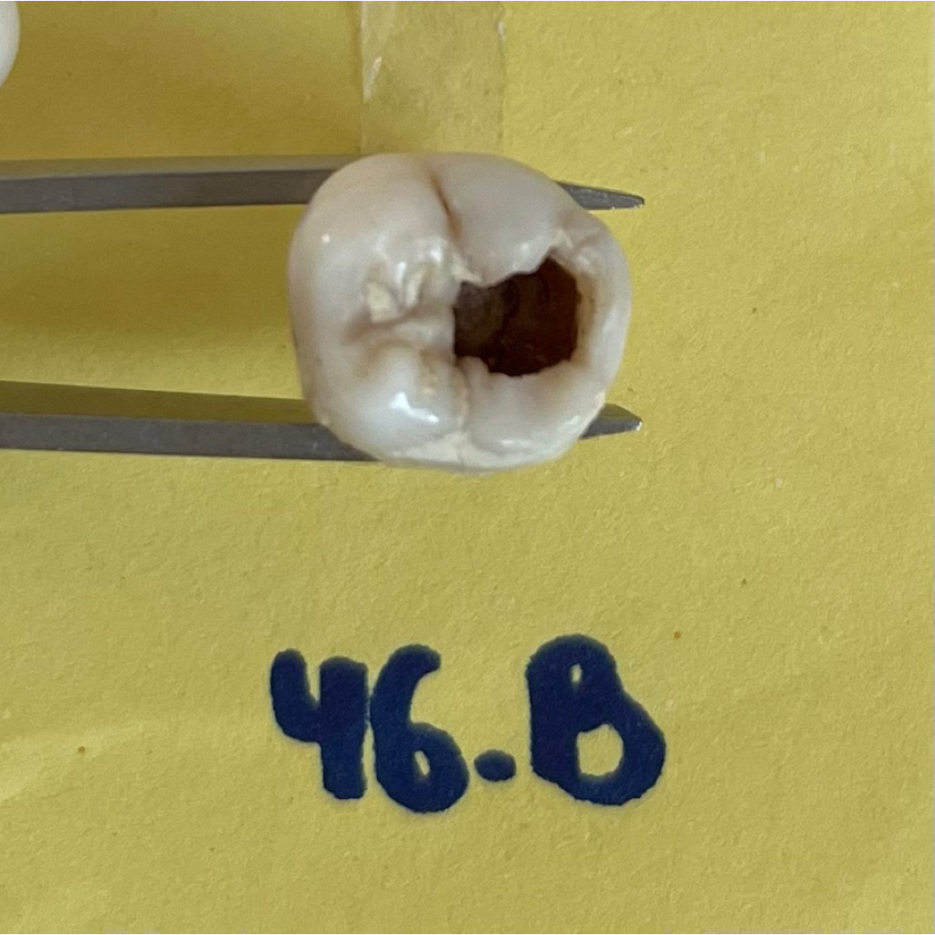 Molar Karies Gigi Asli Praktikum FKG