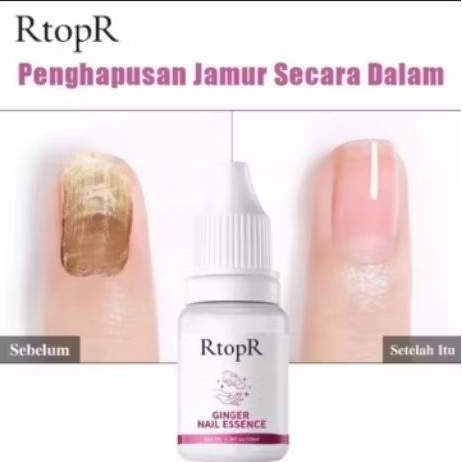 RtopR GINGER NAIL ESSENCE TREATMENT | PERAWATAN JAMUR KUKU, KUKU RUSAK/TIDAK SEHAT