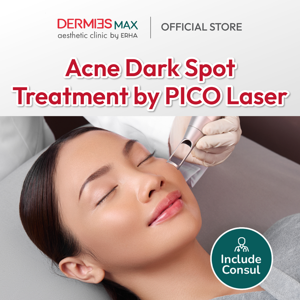 Dermies Max Acne Dark Spot Treatment by PICO Laser