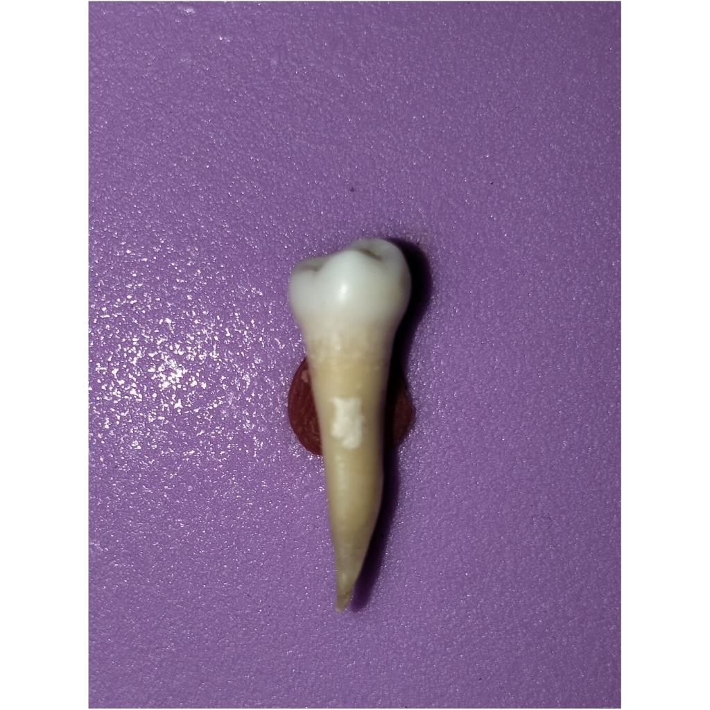 Gigi asli premolar 35