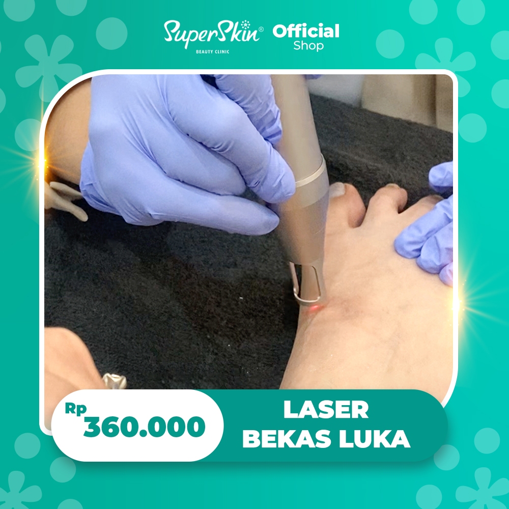 Superskin Treatment Laser Bekas Luka - Menghilangkan Bekas Luka