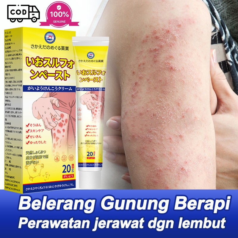 Salep eksim Salep Belerang Cream Anti Gatal 20g Untuk dermatitis kulit, eksim kulit, gigitan serangg