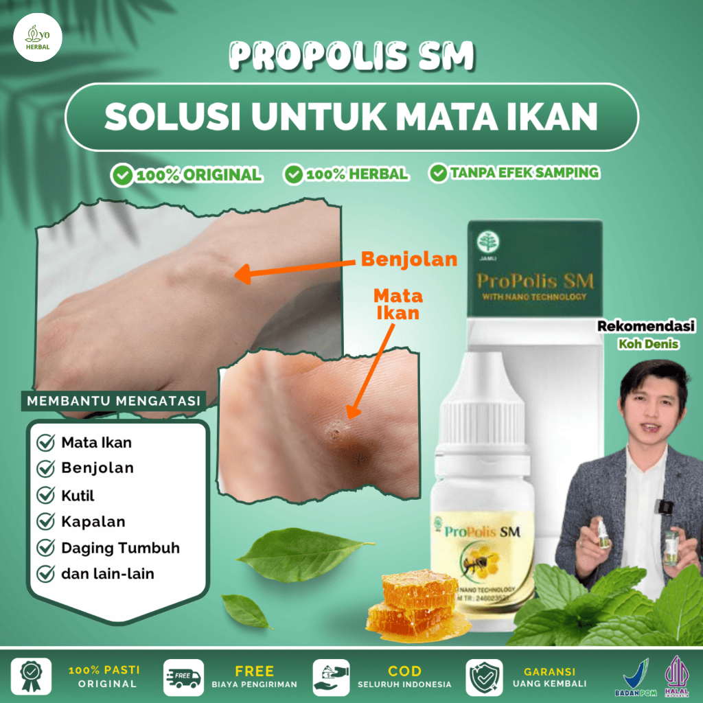 Propolis SM Obat Tetes Mata Ikan di Telapak Kaki di Tangan, Penghilang Benjolan, Kutil AMPUH DAN TER