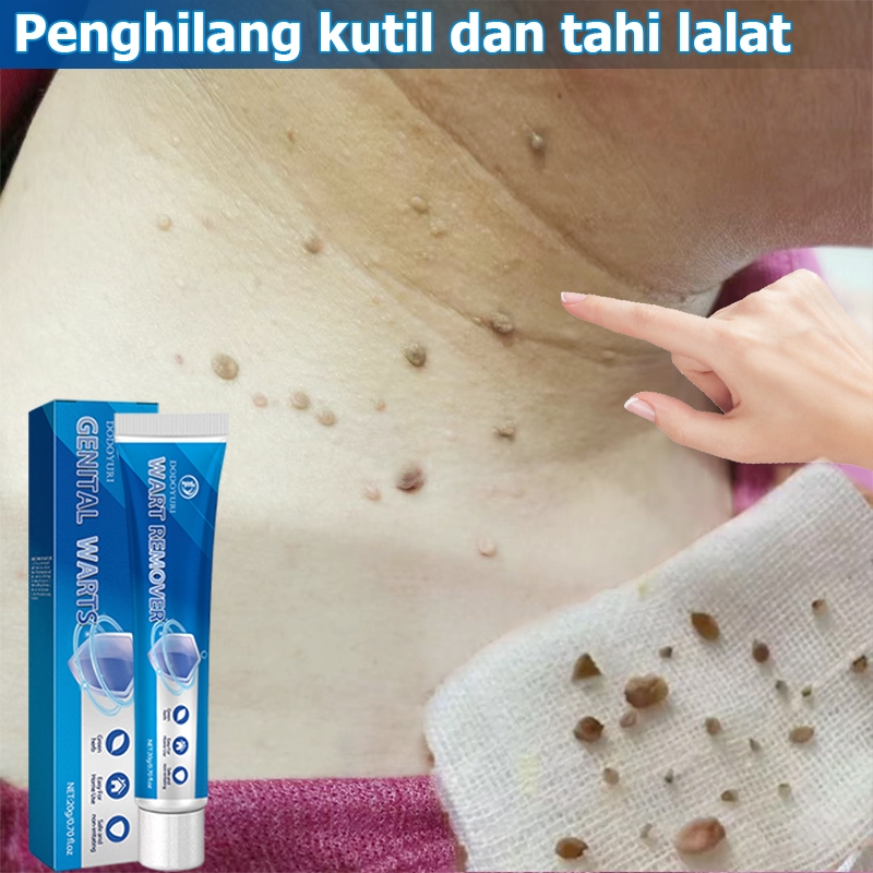 DODOYURI Penghilang kutil dan tahi lalat Penghilang tahi lalat di wajah Penghilang kutil 20g Obat pe