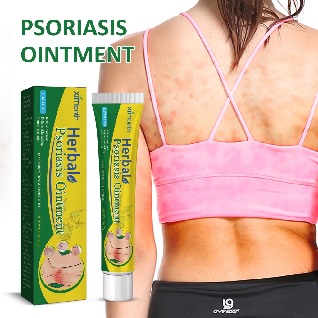 Ximonth Seborrheic Dermatitis Cream 50g Salep Khusus Psoriasis Obat Gatal Eksim Krim Psoriasis Palin