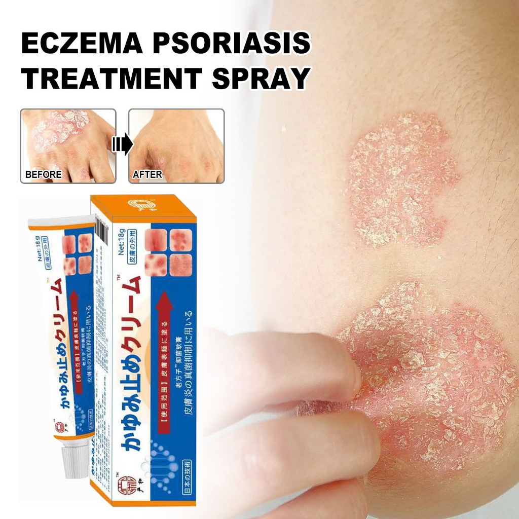 Japan Salep Gatal Paling Ampuh Obat Psoriasis Obat Gatal Salep / Salep Gatal Paling Ampuh untuk Peny