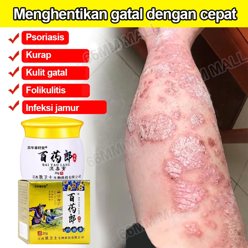 Salep Eksim Kering Dan Gatal Salep Gatal China Paling Ampuh Obat Gatal Selangkangan Salep Bayi Untuk