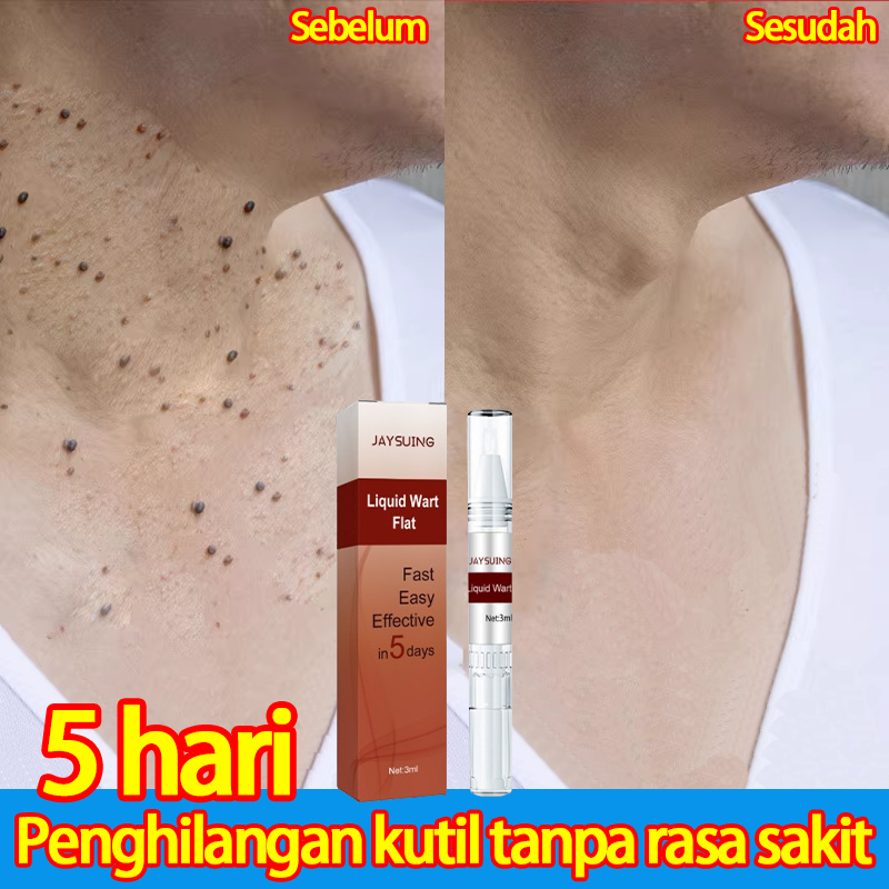 Obat Kutil Penghilang Kutil Dan Tahi Lalat Leher Penghilang Kutil Di Wajah Callusol Mata Ikan Salep 