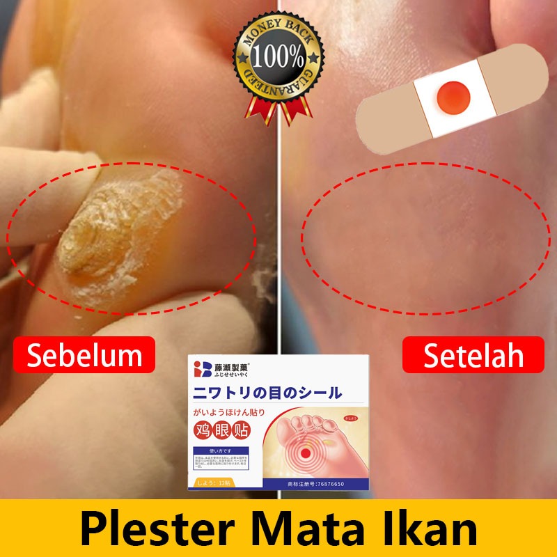 Plester Mata Ikan Paling Ampuh Jepang 0bat Mata Ikan Di Kaki Penghilang Mata Ikan Di Tangan Foot Cor