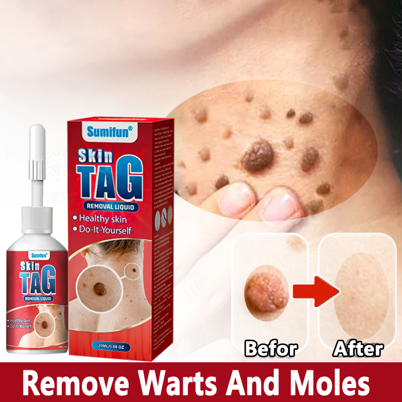 Obat kutil paling ampuh Salep kutilSalep Kutil Paling Ampuh 20g Obat Kutil Ampuh Kelamin Penghilang 