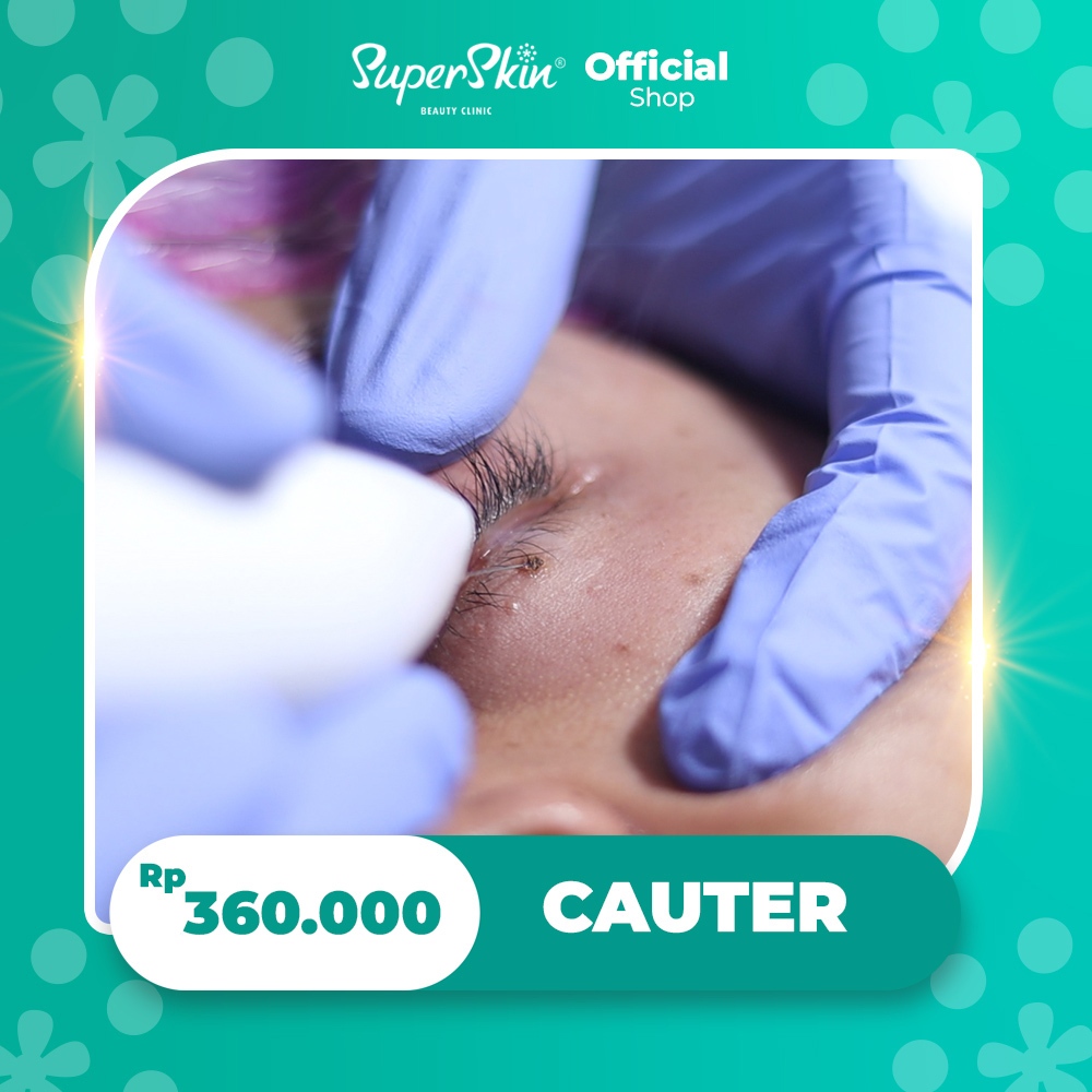 Superskin Cauter - Menghilangkan Milia - Kutil - Jerawat Batu - Tahi Lalat - Syringoma