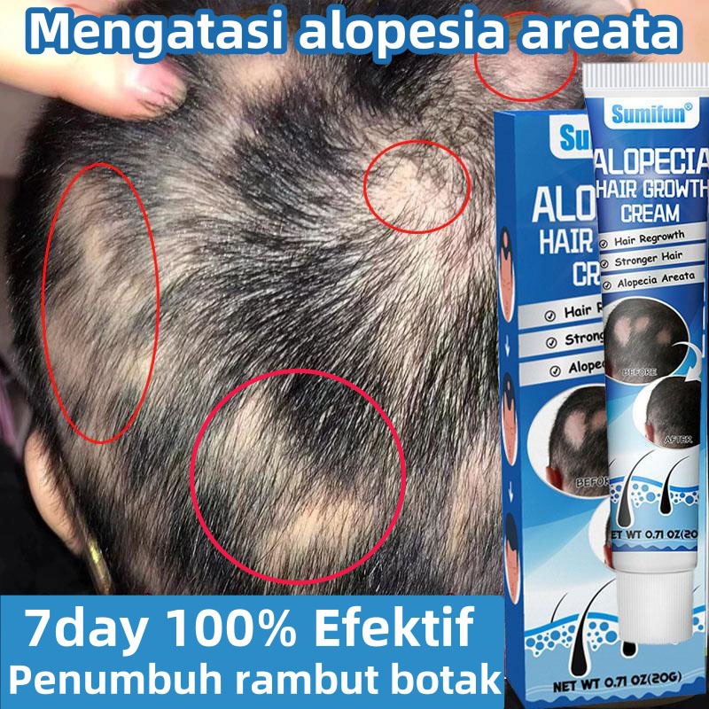 Krim botak kepala Obat Alopecia Areata, penumbuh rambut cepat Obat, penumbuh rambut botak pria dan w
