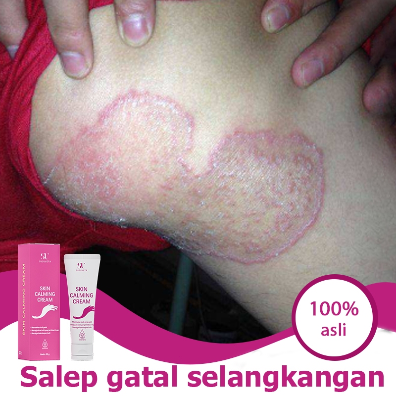 Obat gatal selangkangan dan hitam salep gatel salep salap gatal kulit yang ampuh 20g salep eksim ker