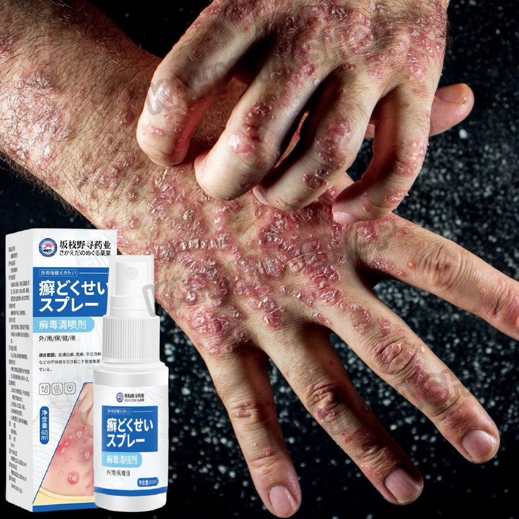 Salep gatal paling ampuh Obat psoriasis obat gatal salep kutil Obat Gatal Salep gatal Salep psoriasi