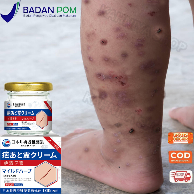 Salep penghilang bekas luka penghilang bekas luka hitam koreng obat penghilang bekas luka Menghilang