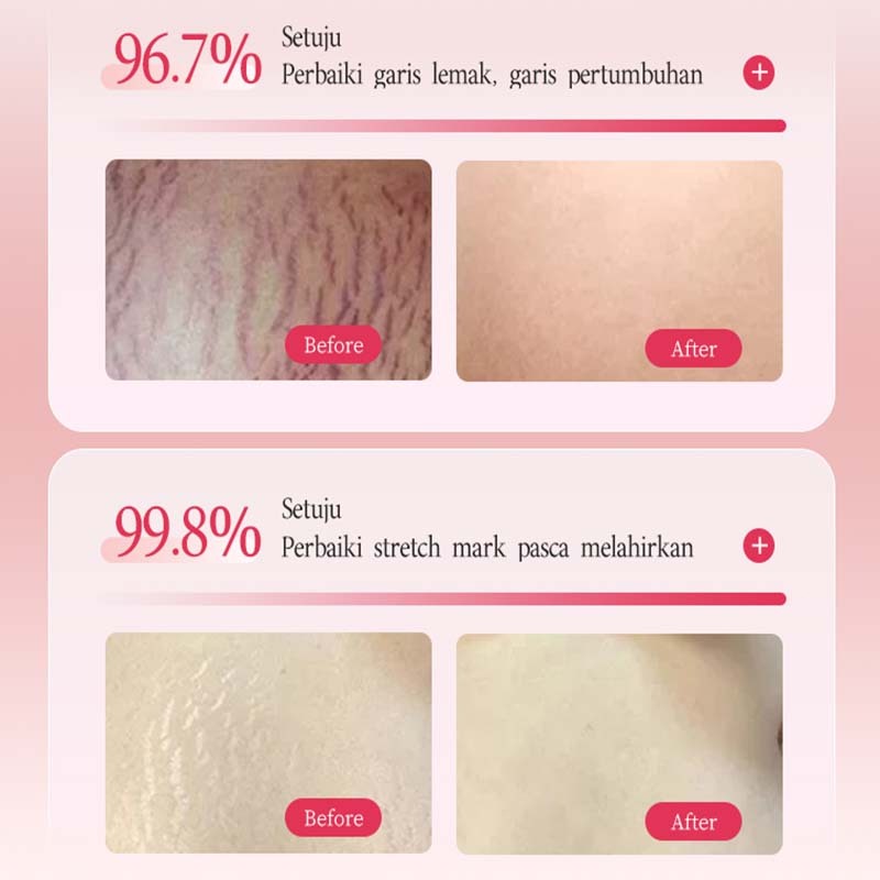 Stretch Mark Cream Stretch Mark Oil Penghilang Strechmark Cream Stretch Mark Paling Ampuh