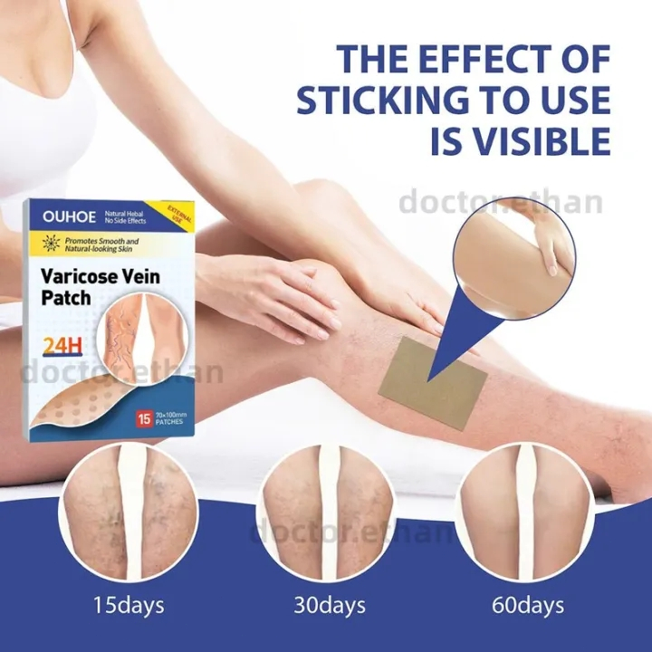 OUHOE 15pcs Koyo Varises Penghilang Varises Di Kaki Varicose Patch Obat Varises Herbal Koyo Varicose