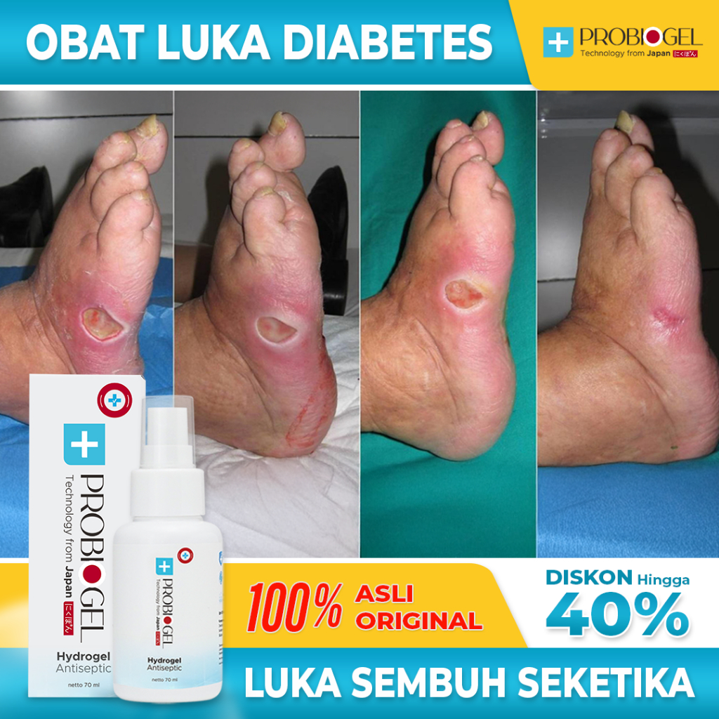 Obat Luka Diabetes Gula Darah Luka Bakar Antiseptik Spray Antiseptic Probiogel Hydrogel