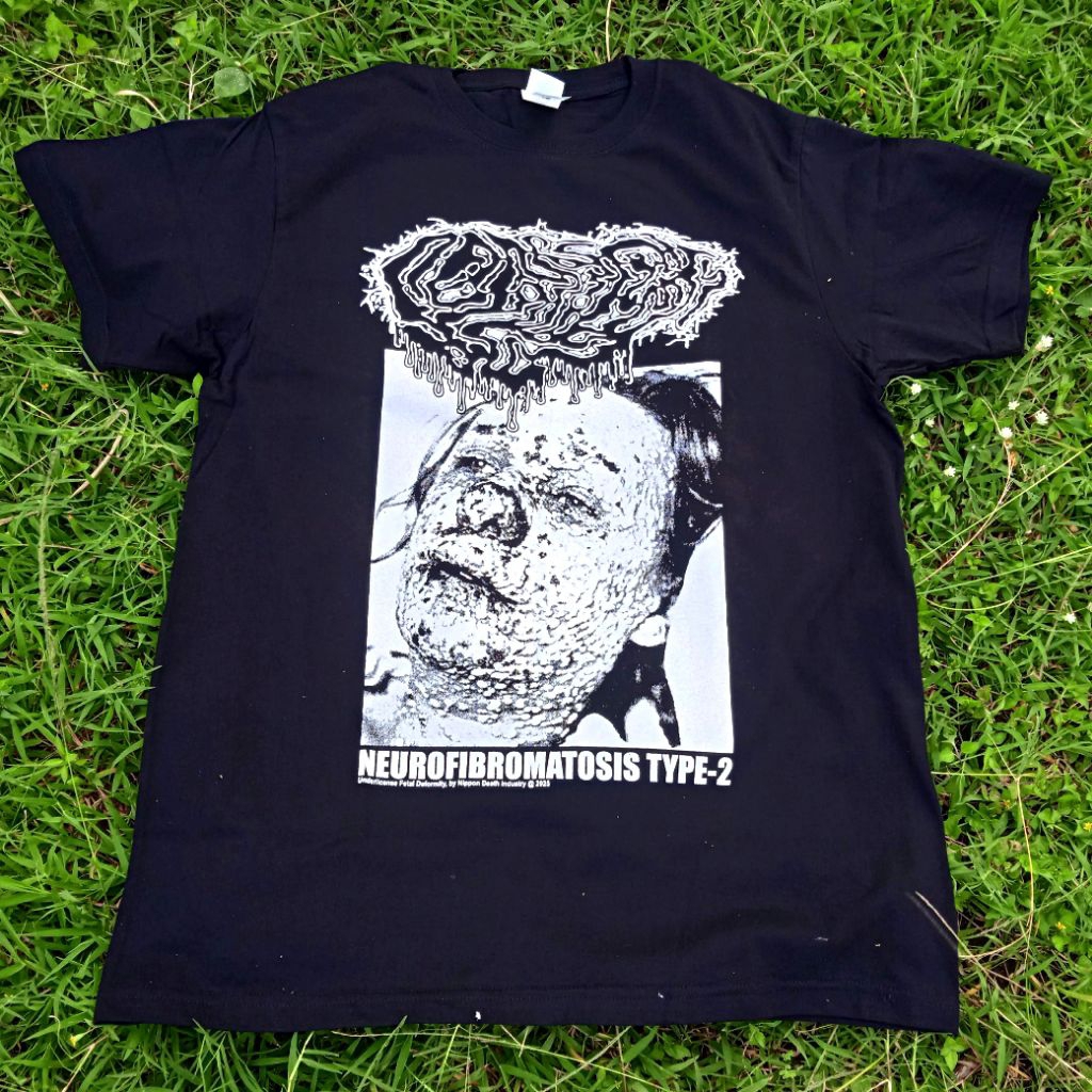 FETAL DEFORMITY - MEXICO GORE GRIND DEPARTMENT