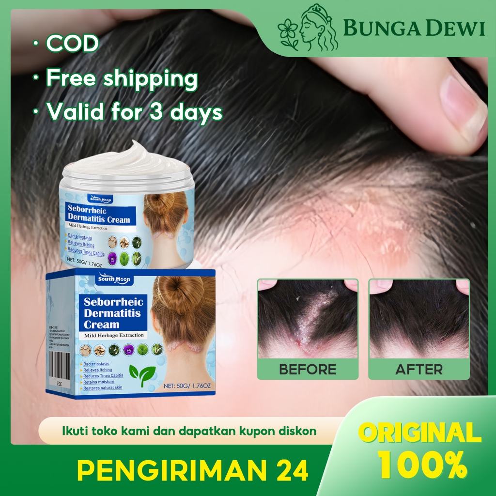 South Moon Seborrheic Dermatitis Cream 50g Krim Kulit Gatal Obat Kulit Kepala Psoriasis Dermatitis S
