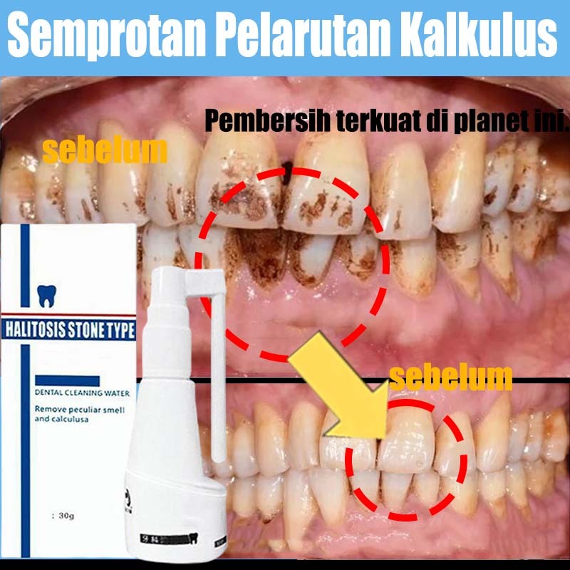 Pembersih karang gigi Pembersih gigi kuning dan karang Karang gigi perontok Pembersih karang gigi be