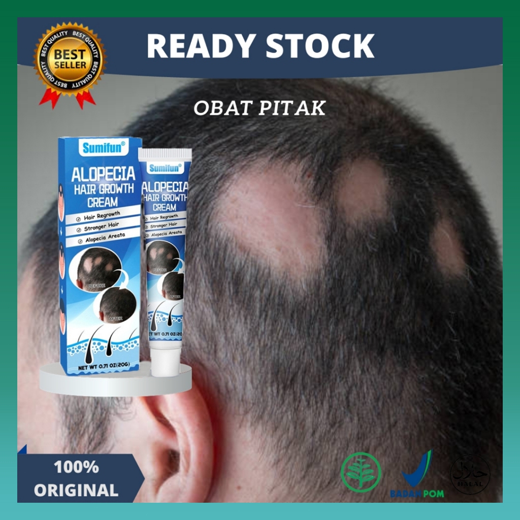 Obat alopecia areata, obat penumbuh rambut cepat