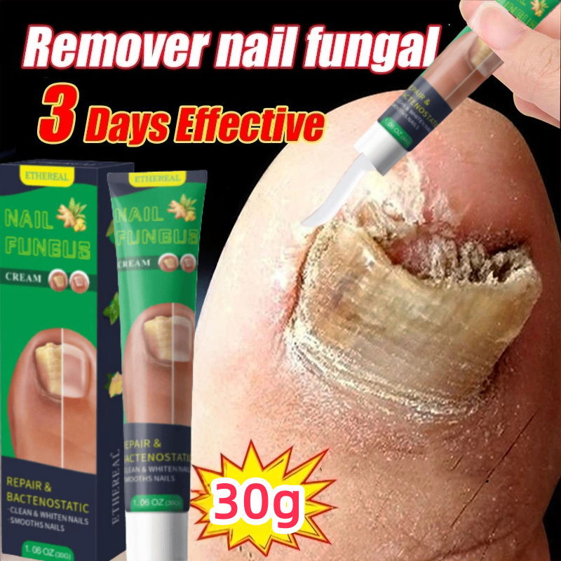 Obat Jamur Kuku Obat Kuku Jamur Dan Rusak Obat Cantengan Jempol Kaki Perawatan Kuku Obat Kuku Jamur 