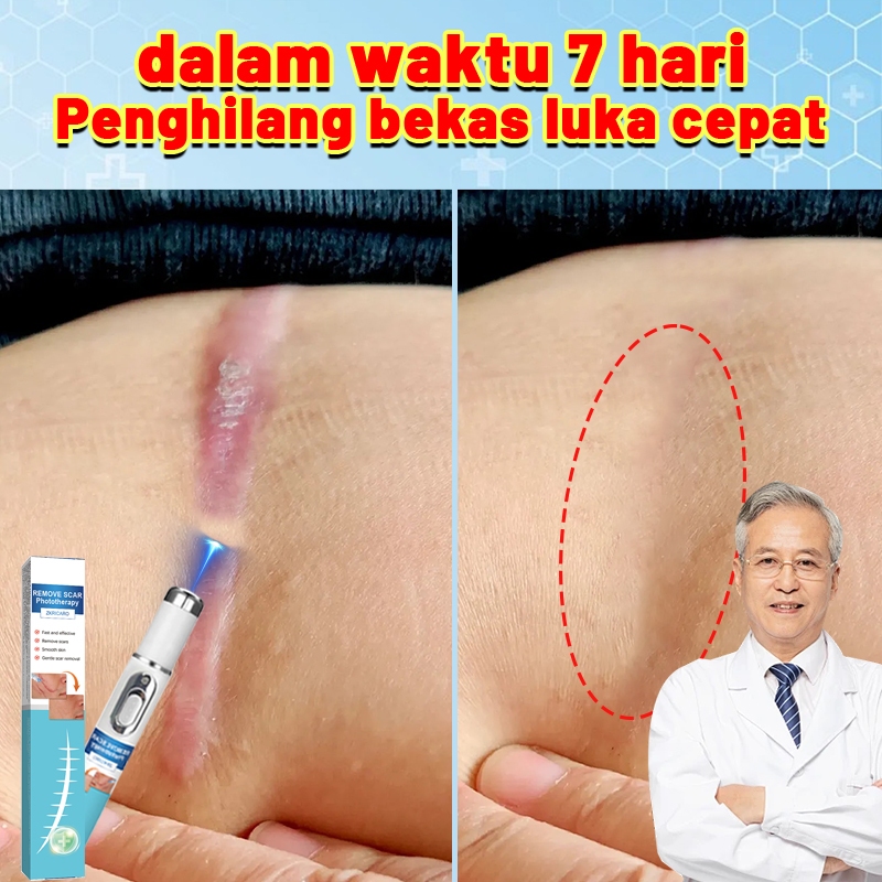 Penghilangan bekas luka laser - kecantikan, bekas luka datar, bekas luka bakar, bekas luka hipertrof