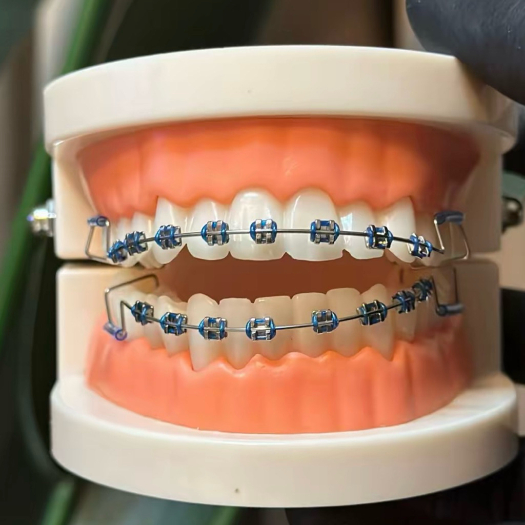 click braces original malay - behel lepas pasang asli malay thailand