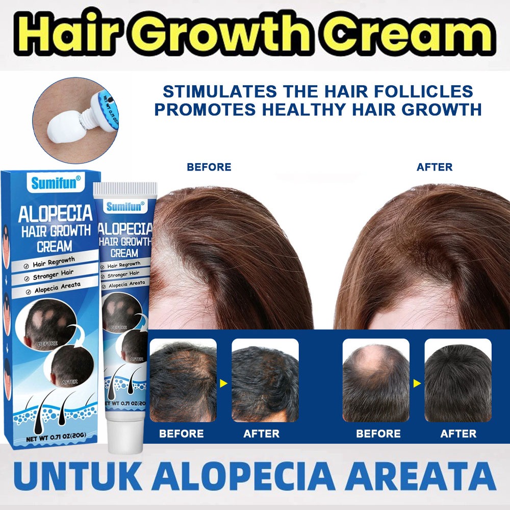 Obat Alopecia Areata, Obat Penumbuh Rambut Botak, Obat Botak Koin, Obat Banyak Pitak, Obat Rambut Pi
