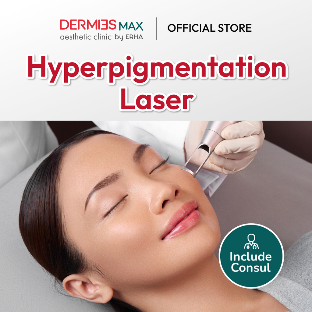 Dermies Max Hyperpigmentation Laser