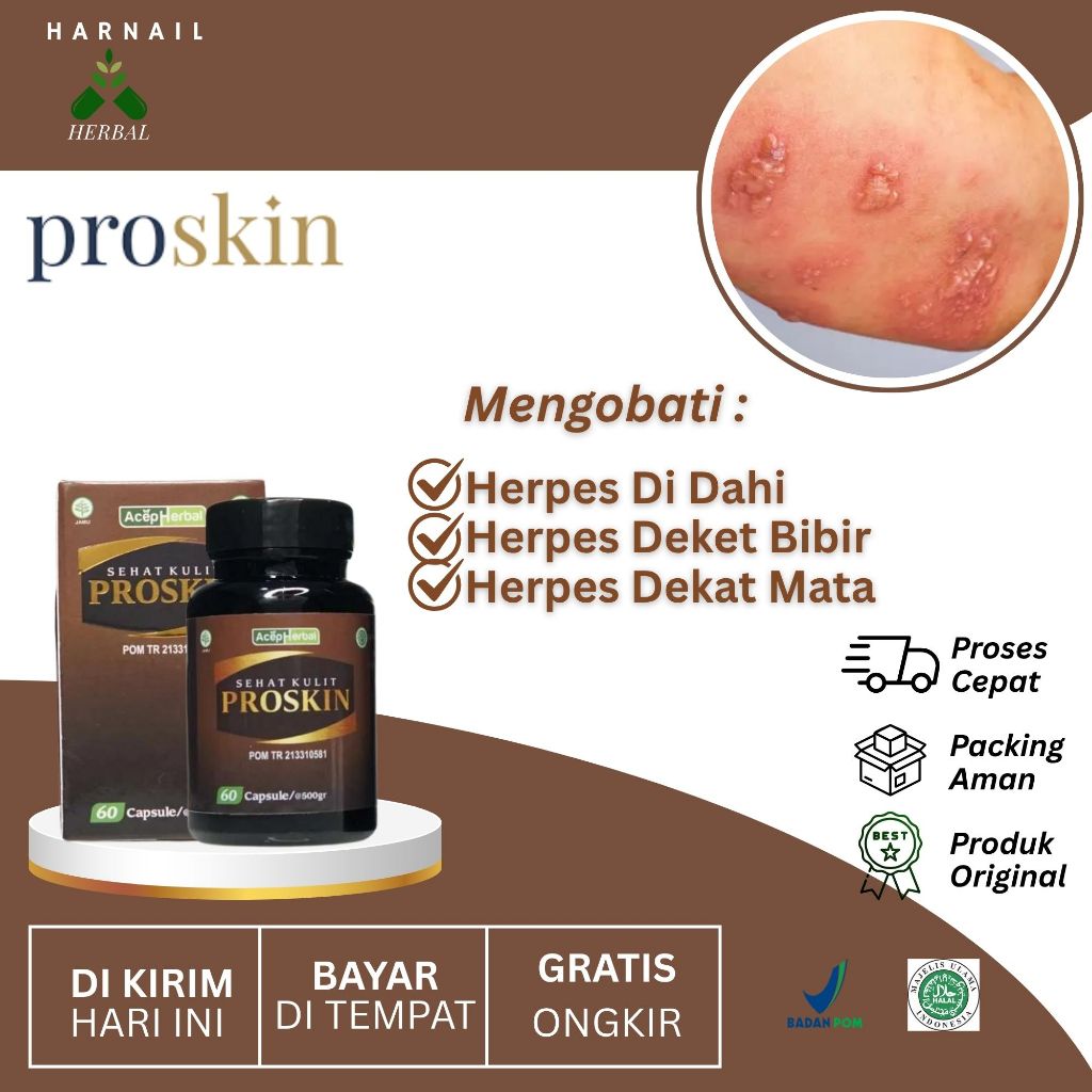 Obat Untuk Herpes Di Dahi Herpes Deket Bibir Herpes Dekat Mata Dengan Proskin EKstrak Daun Binahong 