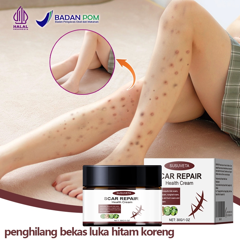 SUSUVETA Bekas luka hitam di kaki Penghilang bekas luka hitam koreng Menghilangkan bekas luka
