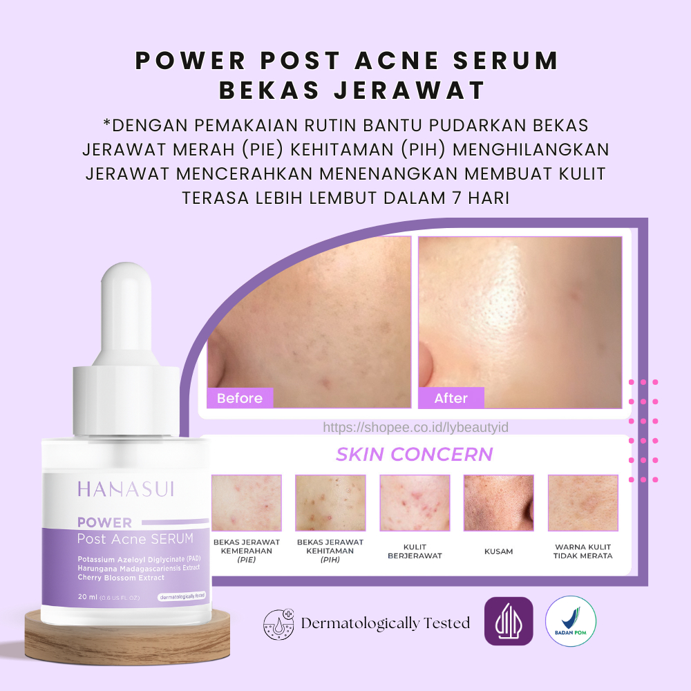 Serum Penghilang Bekas Jerawat Merah (PIE) Hitam (PIH) Kemerahan Mencerahkan Kulit Kurangi Kemerahan