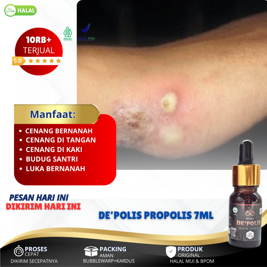 Obat Scabies / Skabies, Kudis Budug Gudig Budukan, Kutu Scabies, Bentol Berisi Air Dan Nanah Pada Ja