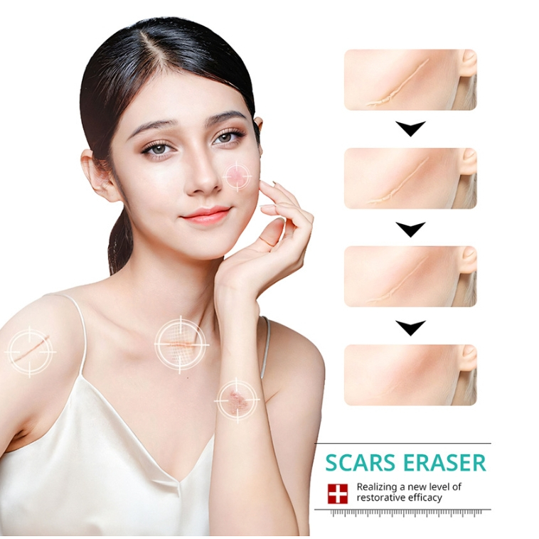 Maycheer Scar Removal Cream Peklat Remover Acne Treatment Old Scar RemoverCream Stretch Mark Cream