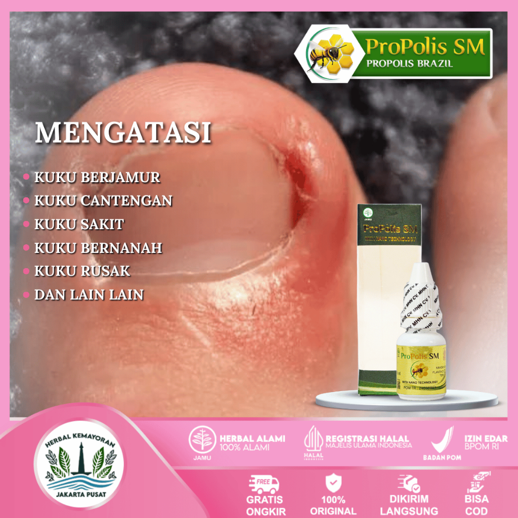 Obat Cantengan Parah Jempol Kaki Bengkak Bernanah Tangan Cantengan Kukuk Rusak Propolis Brazilian SM