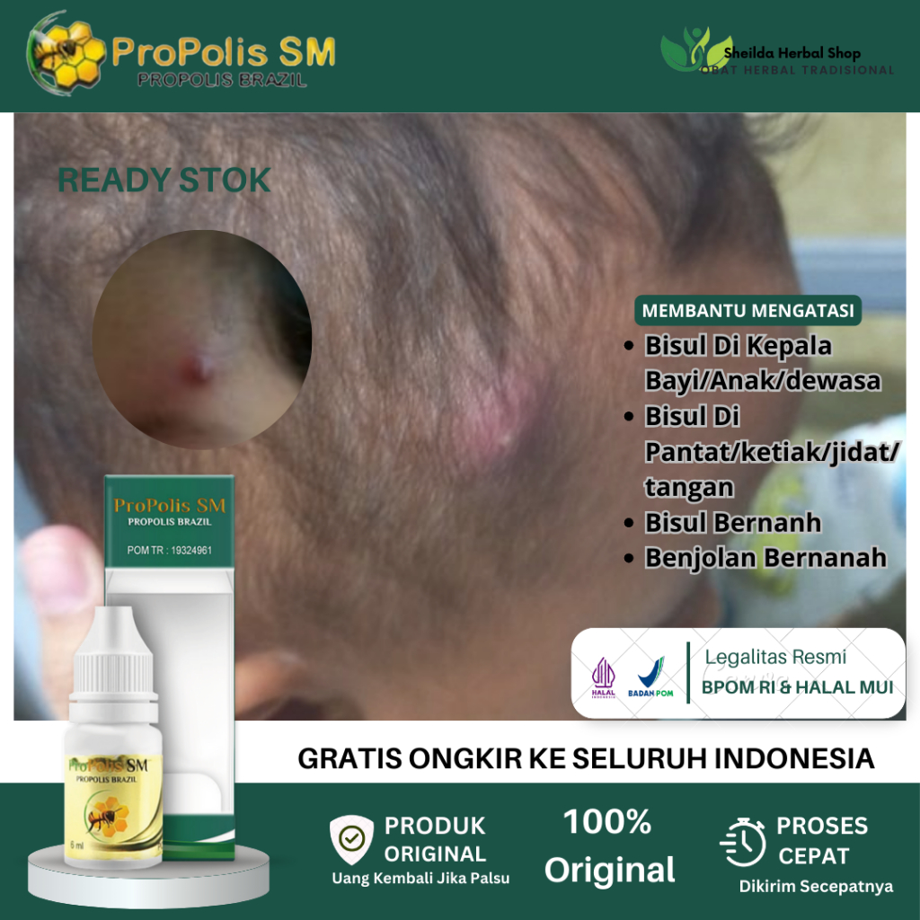 Propolis SM Bisul, Bisul Bernanah, Bisul Di Kepala Bayi / Anak / Dewasa, Bisul Biar Gak Tumbuh Lagi,