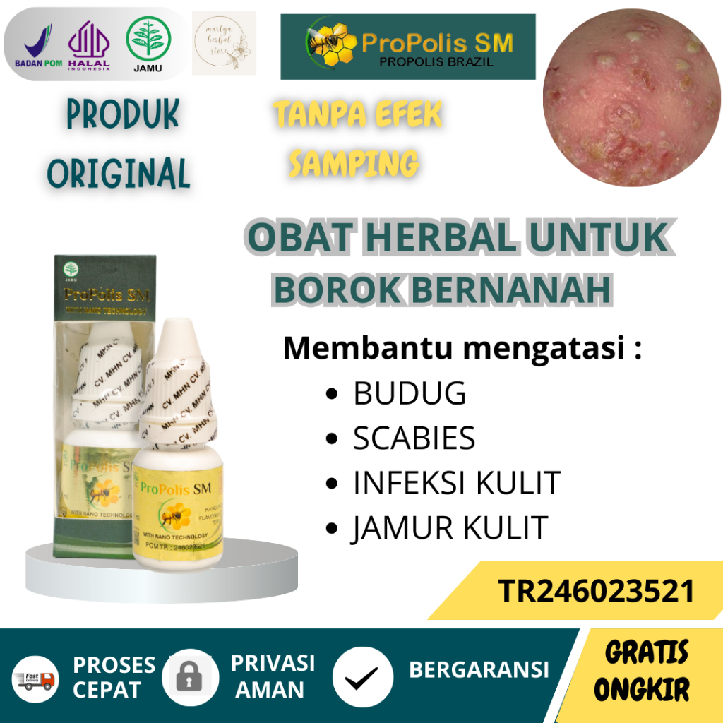 Obat Herbal Borok Bernanah, obat Budug Alami, obat Scabies Manusia, Obat Penghilang Bekas Budug, Oba