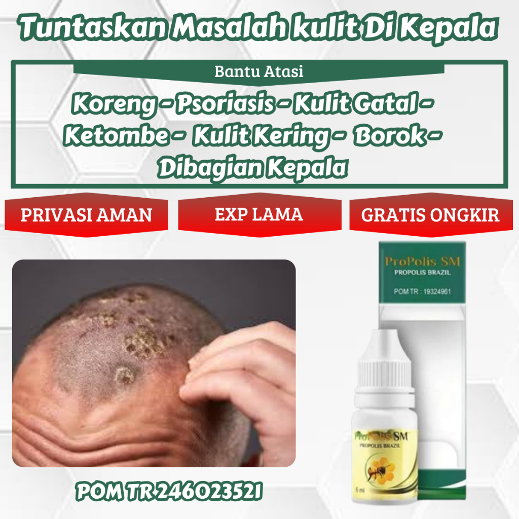 Obat Borok Kulit Kepala Koreng Psoriasis Koreng Di Kepala Kulit Kepala kering Ketombe - Propolis SM