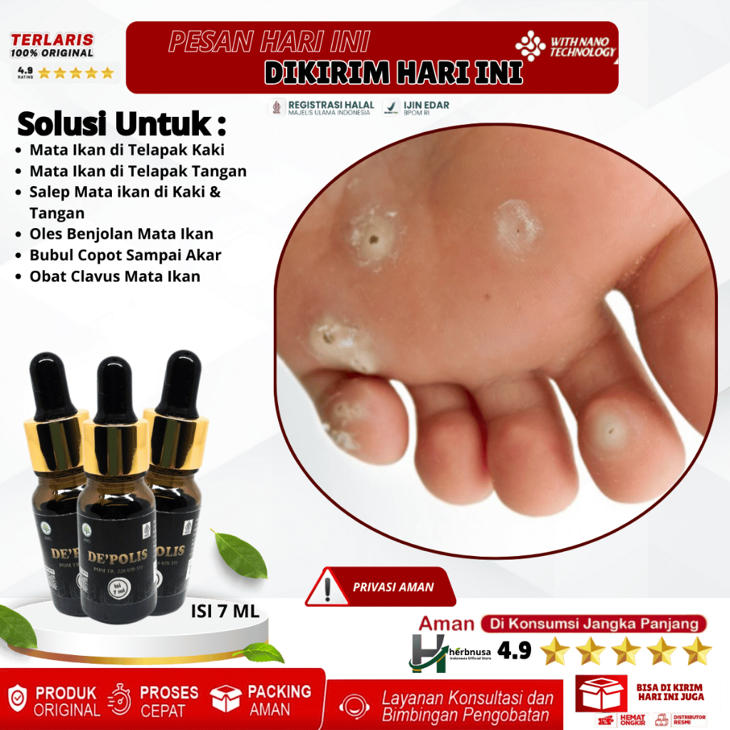 Obat Mata Ikan di Telapak Kaki, Obat Mata Ikan di Telapak Tangan, Salep Mata ikan di Kaki & Tangan, 