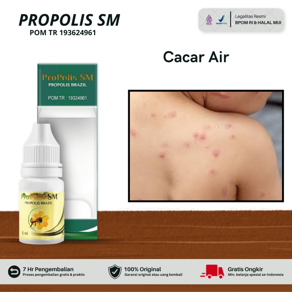 ProPolis SM - Cacar Air Gatal-gatal Berair Bintik-bintik Berair Kulit Luka Lecet Campak Anak dan Dew