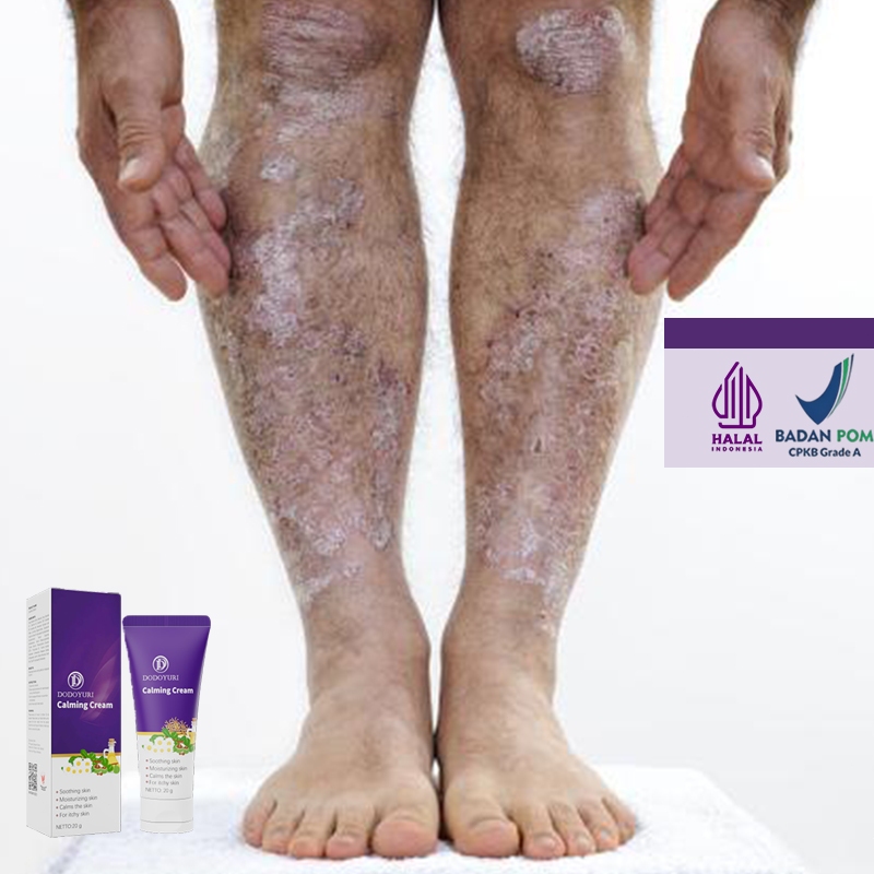 Salep gatal salep china gatal paling ampuh obat gatal obat eksim salep gatal jamur selangkangan 20g 