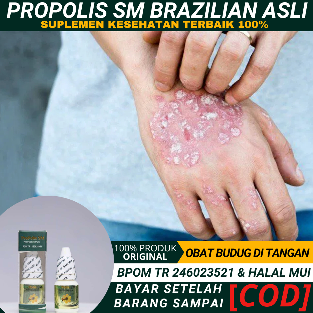 Obat Borok Bernanah Di Tangan, Cenang Bernanah Di Tangan Anak, Di Kaki, Obat Luka Borok Di Kaki Dan 