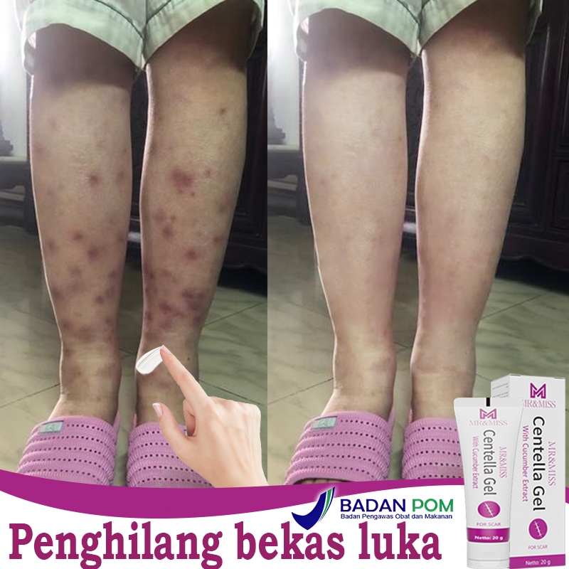 

F_daybose - Salep Penghilang Bekas Luka 20gr Atasi Luka Koreng Gigitan Nyamuk Keloid Stretchmark